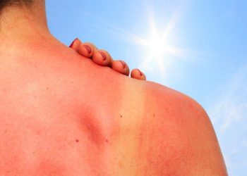 Ja çfarë duhet të bëni që të trajtoni djegiet nga dielli