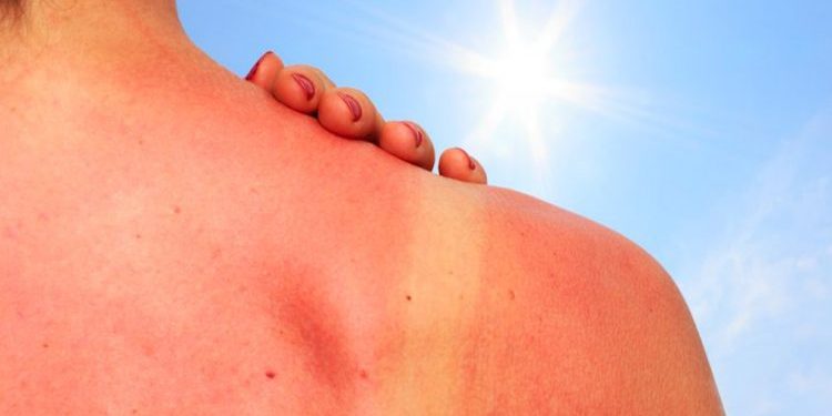 Ja çfarë duhet të bëni që të trajtoni djegiet nga dielli