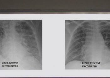 Efikasiteti i vaksinës mund të shihet në këto 2 fotografi të mushkërive