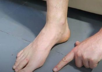 Ja çfarë duhet të bëni kundër deformimeve të nyjave të shputave