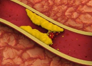 Kolesteroli i lartë i gjakut, vrasës i heshtur