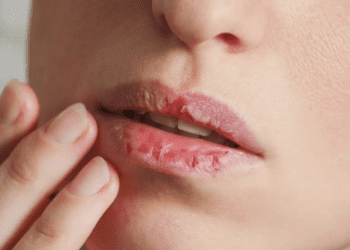 Si t’i shëroni buzët kur qahen gjatë dimrit?