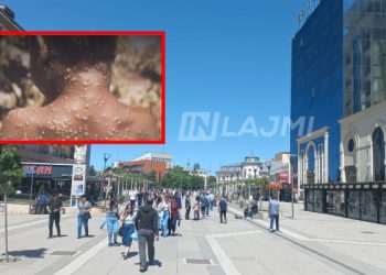 A rrezikohet Kosova nga “Lia e Majmunëve”, flet infektologu kosovar