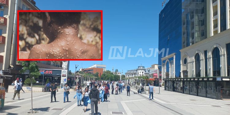 A rrezikohet Kosova nga “Lia e Majmunëve”, flet infektologu kosovar