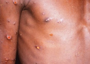 Nis me ethe dhe dhimbje të kokës, këto janë simptomat e lisë së majmunëve