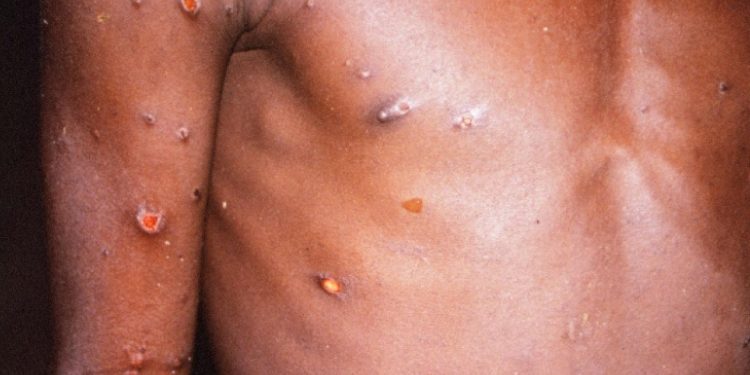 Nis me ethe dhe dhimbje të kokës, këto janë simptomat e lisë së majmunëve