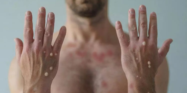 Evropa shënon vdekjen e parë nga lija e majmunit