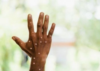 Arrinë lija e majmunit në Malin e zi, raportohet për rastin e parë të infektuar