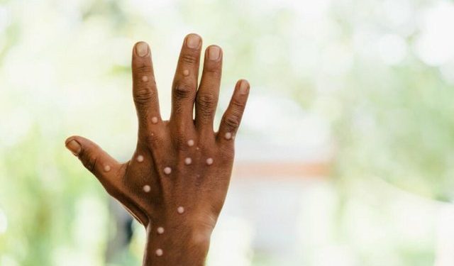 Arrinë lija e majmunit në Malin e zi, raportohet për rastin e parë të infektuar