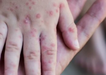 Në Gjermani identifikohet rasti i parë i fëmijës së infektuar me linë e majmunëve