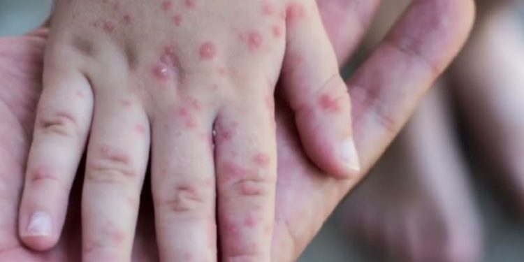 Në Gjermani identifikohet rasti i parë i fëmijës së infektuar me linë e majmunëve