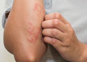 Disa nga arsyet e kruarjes së lëkurës!