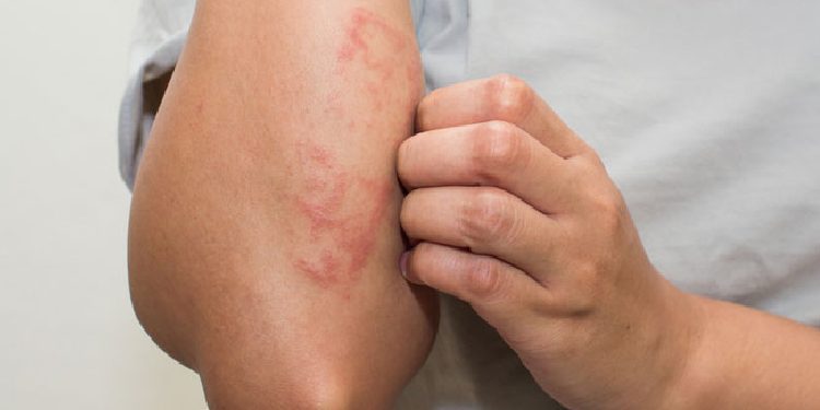 Disa nga arsyet e kruarjes së lëkurës!