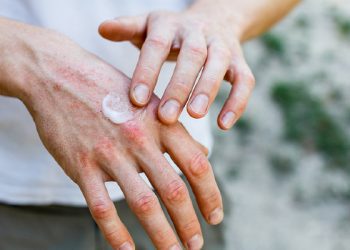 Dimri “armik” i lekurës, por ja zgjedhja për mbrojtje!