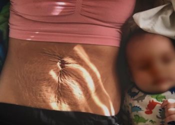 Barku pas lindjes, pse ndryshon dhe si ta tonifikojme