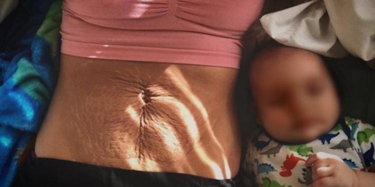 Barku pas lindjes, pse ndryshon dhe si ta tonifikojme