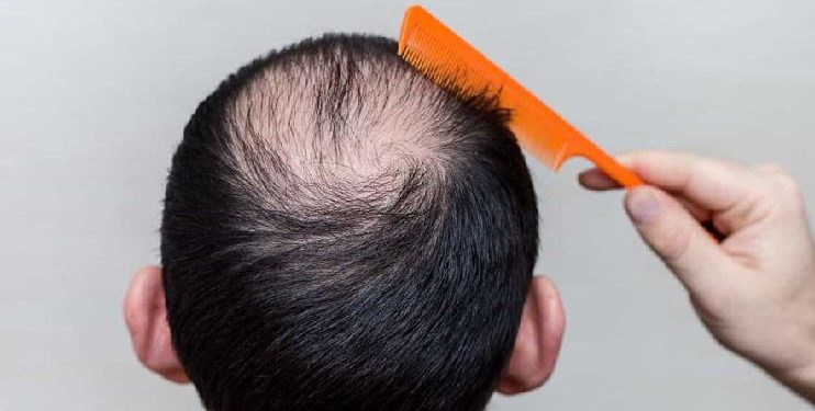 Rënia e flokëve të burrat, çfarë e shkakton dhe si duhet ta parandaloni?