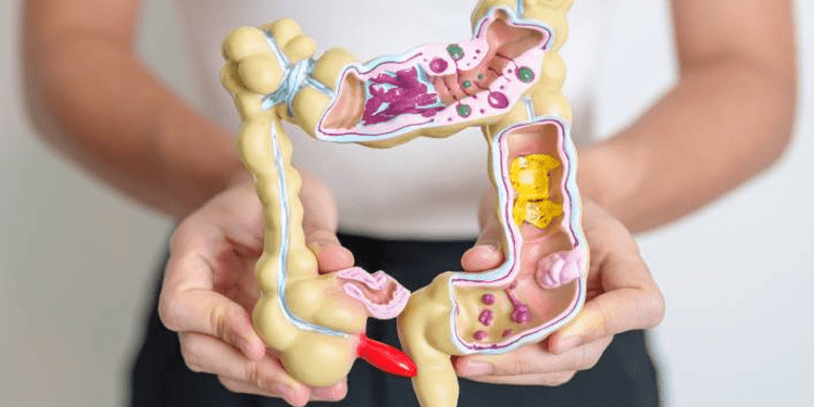 Cilat ushqime e shkaktojnë inflamacioni i zorrës së trashë dhe kujdesi që ju duhet patjetër