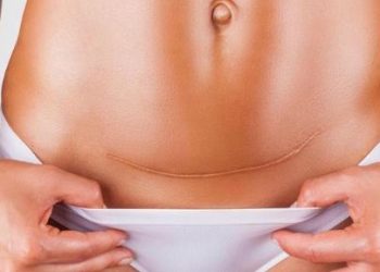 Sa operacione çezariane mund të përballojë një grua pas lindjes