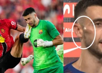 Kështu duket fytyra e portierit Garcia pas ndërhyrjes brutale të Vedat Muriqit