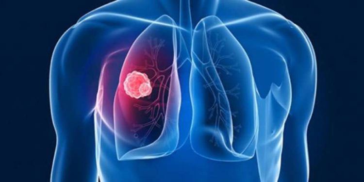 548 raste të reja me tuberkuloz për vitin 2024